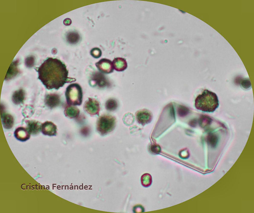 Cristales de urato y estruvita en orina de un perro con infección bacterinan