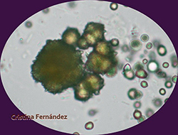 Cristal de urato e infección bacteriana